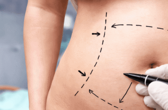 How Does Liposculpture Work? A Step-by-Step Have a look at the Process