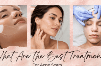 What Are the Finest Therapies for Zits Scars?