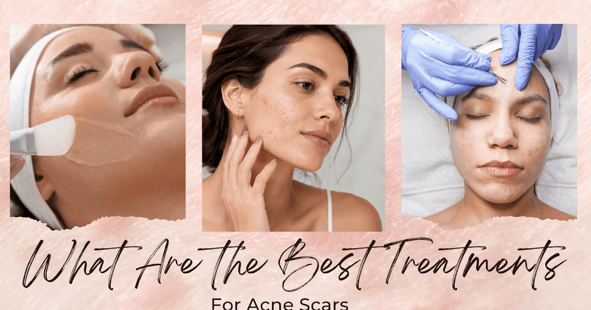 What Are the Finest Therapies for Zits Scars? What Are the Finest Therapies for Zits Scars?