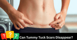 Do Tummy Tuck Scars Disappear—Or Can They Turn into a Masterpiece?