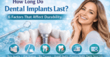How Lengthy Do Dental Implants Final? 6 Elements That Have an effect on Sturdiness
